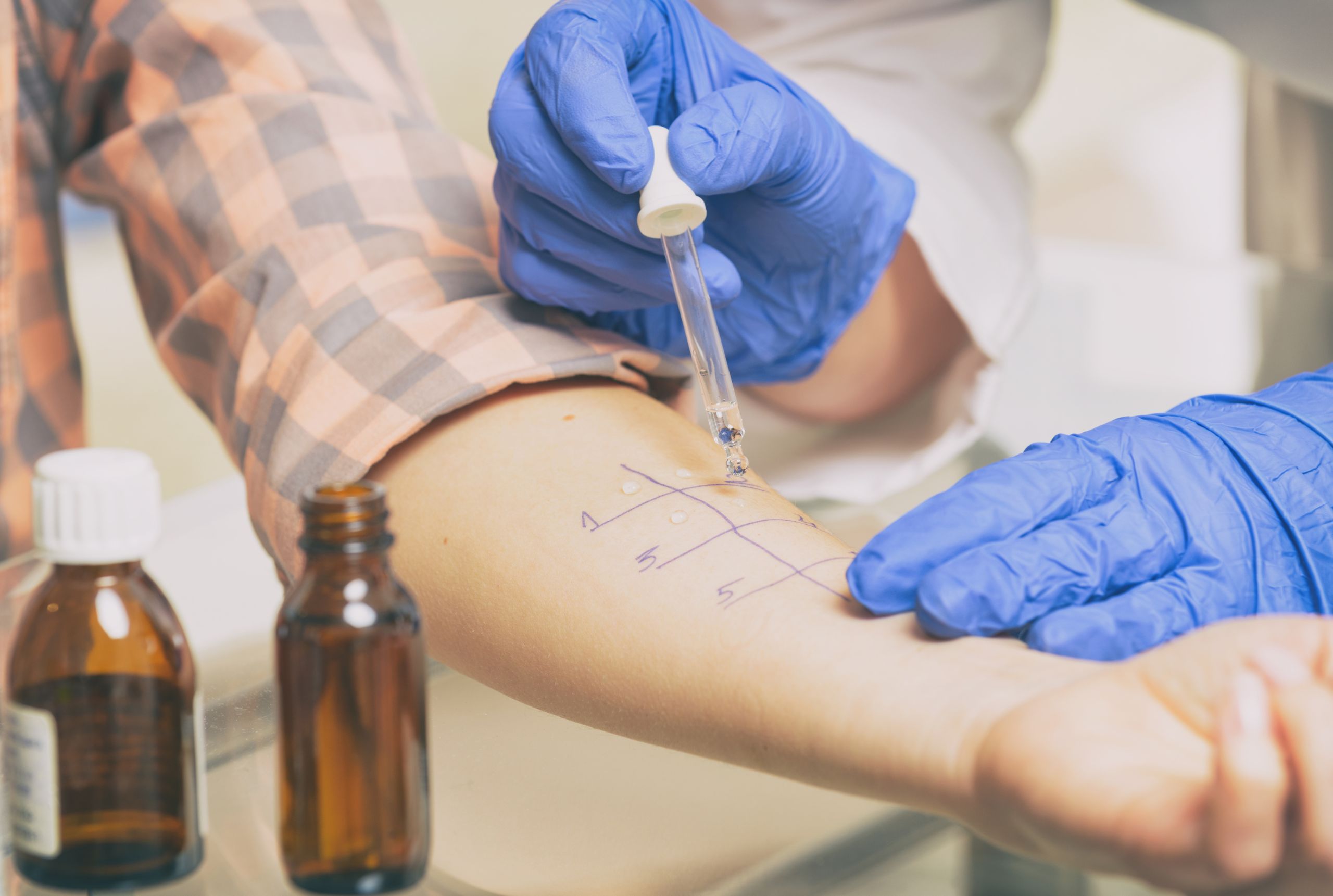 A close-up of what appears to be an allergy test on a patient's arm